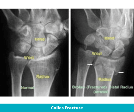Where Is R Colles Colles Fracture: Types, Symptoms & Physiotherapy Management